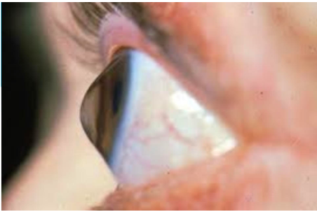 Keratoconus Example