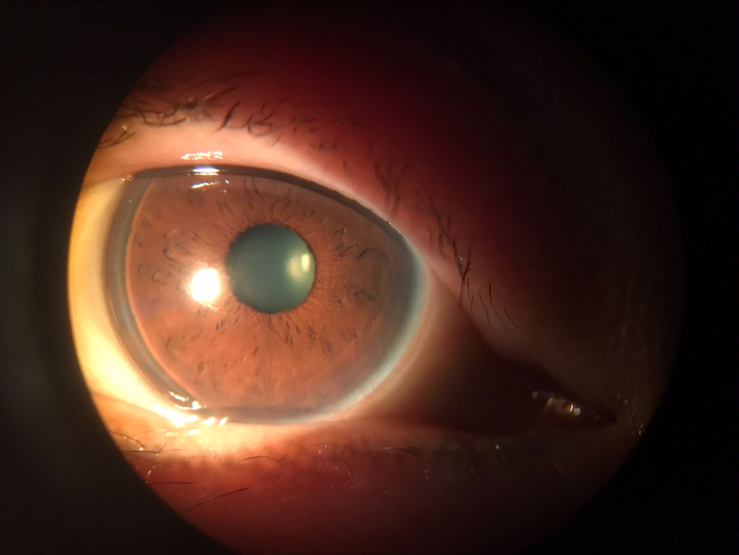 Hyperopic Presbyopia Ortho-K