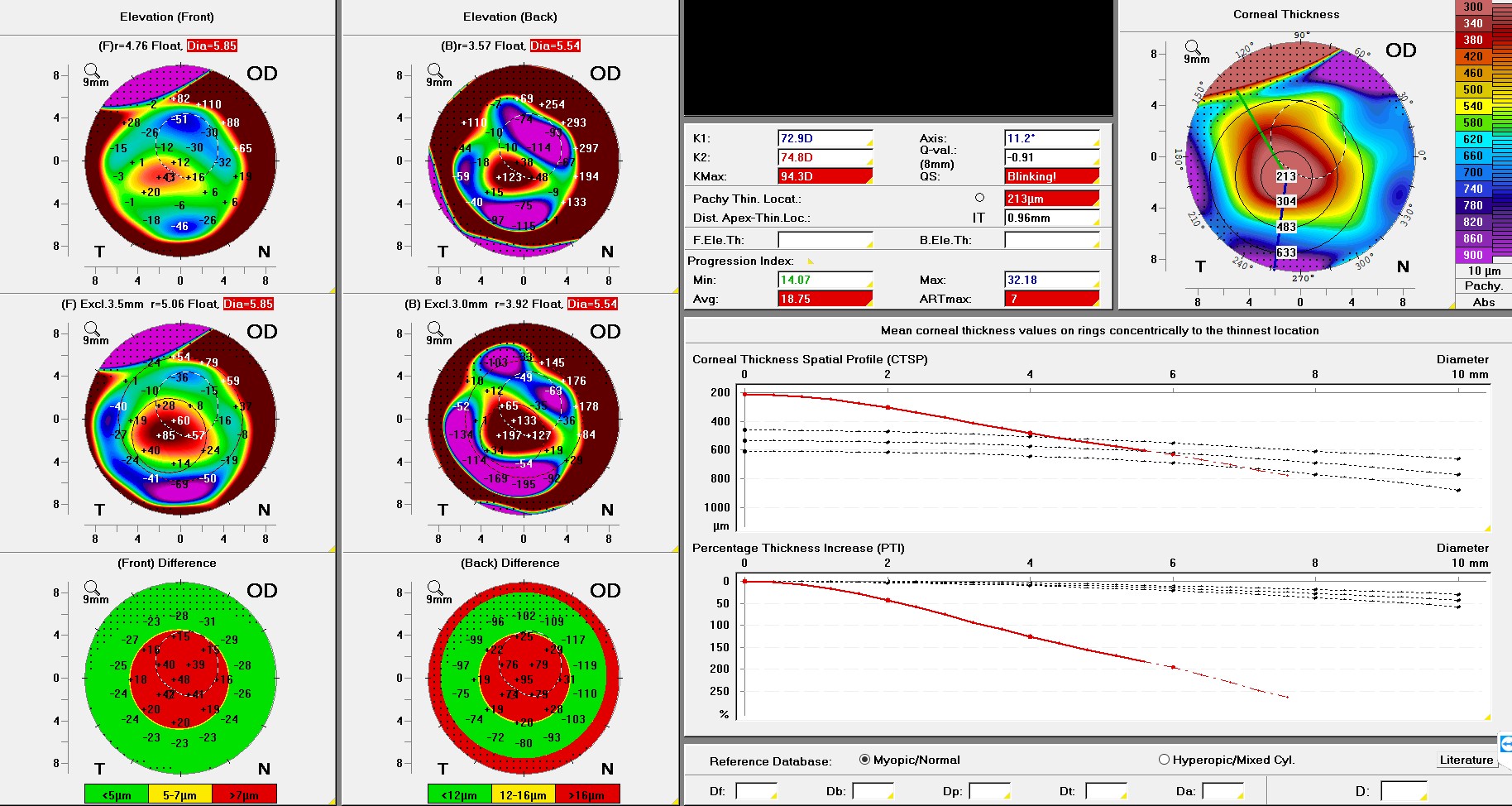 Pentacam Enhanced Ectasia Screening Tool